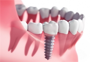 Significant Details You Need To Know About Dental Implants