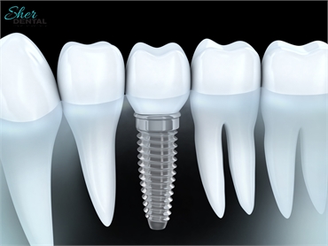 How Much Does A Dental Implant Cost In Miami