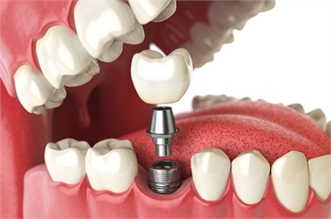 Clearing The Myths Around Dental Implants 