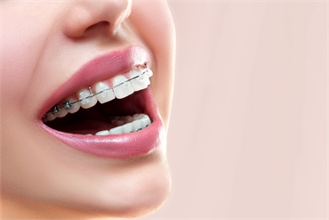 A Look at the quick guide to Transform Your Smile with 6 Month Braces in Miami