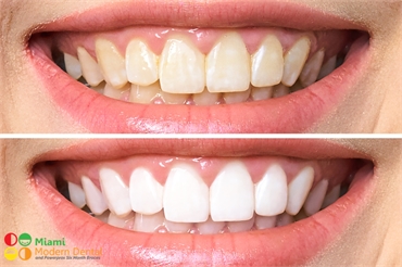 4 Signs That Professional Teeth Whitening Services Are Your Best Option
