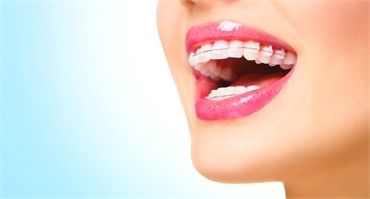 A Look At Tips To Get Affordable Braces For Adults In Miami
