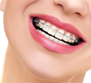 All You Need To Know About Cheap Braces In Miami