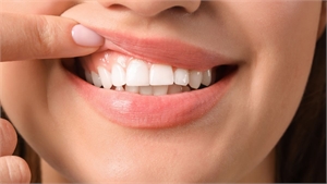 Understanding Gum and Tooth Contouring
