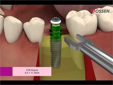 Hiossen Dental Implant ET III Taper