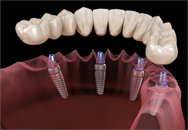 Different Types of Dental Implants and Their Uses