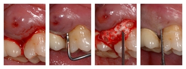 Treatment periodontal abscess