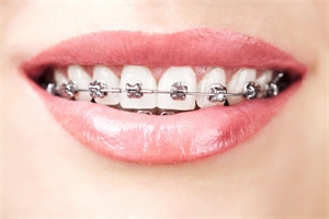 The Differences Between Traditional Dental Braces And Clear Aligners