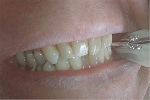 Shimstock in dentistry is a thin foil used to check how the opposing teeth meet each other