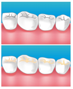 Teeth Sealants