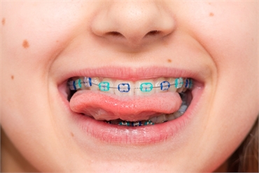 Reasons for Braces and Orthodontic Treatment