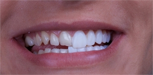 Dental Veneers: Focusing on your physical appearance