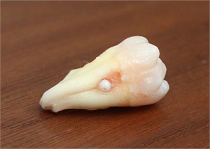 Composite enamel pearl is a type of ectopic enamel