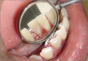 Ectopic enamel on the lingual surface of lower incisor