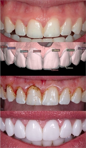 Planning dimensions, shape and shade of dental veneers