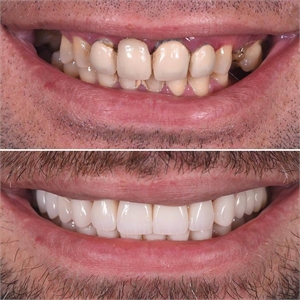 Dental veneers - before and after