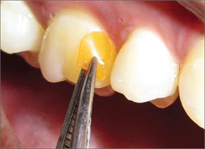 Inserting a Periochip in the periodontal pocket of an upper tooth