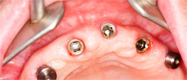 3 Dental Implant Mistakes to Avoid
