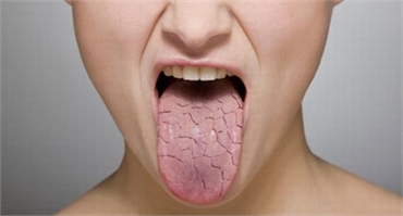 Dry Mouth Syndrome