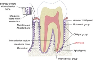 Ankylosis on teeth