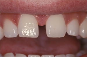 Diastema is a gap between teeth