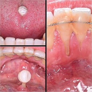 Tongue piercings cause gum recessions on the lingual surface of the anterior incisors.