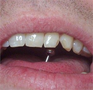 Tongue piercings can cause tooth fractures.