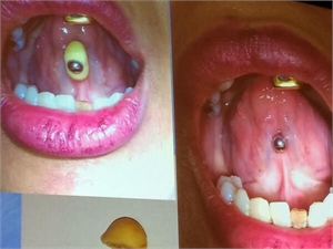Calculus/tartar buildups on tongue piercing. Tartar contains bacteria that may harm the gums and teeth.