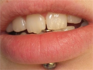 Lip piercings may cause teeth damage and fractures.