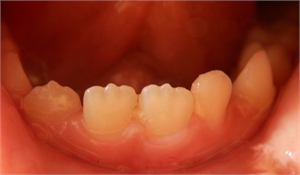 Tooth mamelons are irregularities present on the incisal edges of newly erupted teeth