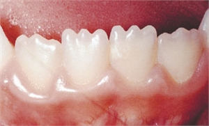 Dental mamelons or teeth mamelons are enamel structures on the cutting edge of incisor teeth