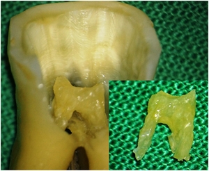 Pulp stone in a cross sectioned tooth