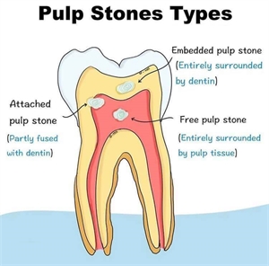 Attached pulp stone, Embedded pulp stone, Free pulp stone