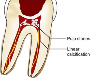 Pulp stones and linear calcifications within the root canal of the tooth