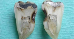 Pulp stones visible in the pulp chamber of this cross sectioned molar tooth