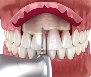 What is crown lengthening in dentistry?