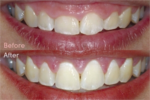 Teeth crowns lengthening - before and after photo