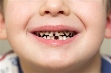 Why does my 4-year-old have so many cavities?
