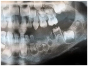 Ghost teeth on x-ray radiograph
