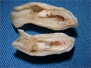 Dens invaginatus on a cross sectioned tooth