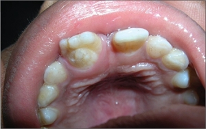 Dens invaginatus on maxillary incisor