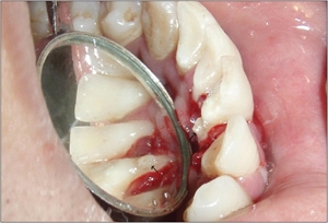 Ectopic enamel on inner surface of the lower incisor