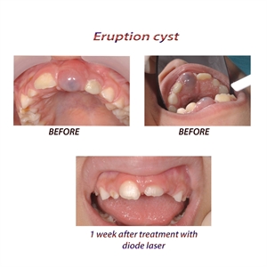 Tooth eruption cyst