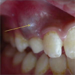 Tooth eruption cyst above a deciduous tooth