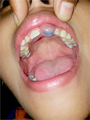 Eruption cyst in the mouth