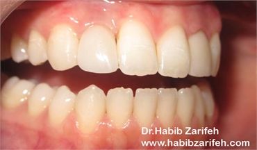 dental implants crowns lebanon