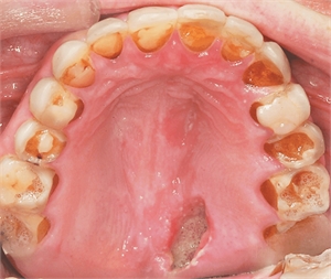 Erosion of the teeth enamel and palatal mucosa due to bulimia nervosa