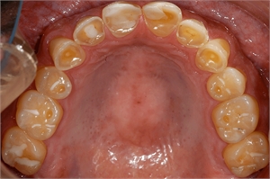 Bulimia Nervosa teeth erosion caused by the gastric acids