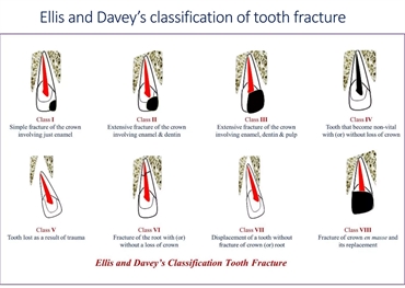 Ellis classification for tooth fracture