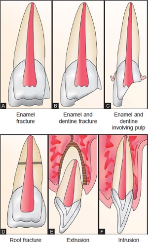 Ellis classification for tooth fractures in dentistry